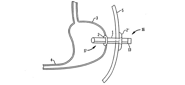 The food extraction system connects the stomach to the abdominal wall (Pic: USPTO)